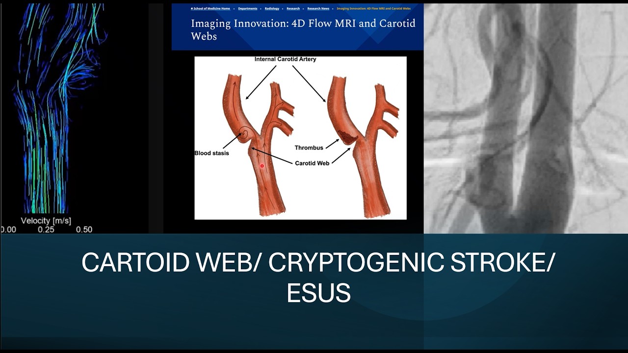 Cryptogenic stroke/ ESUS: Carotid web