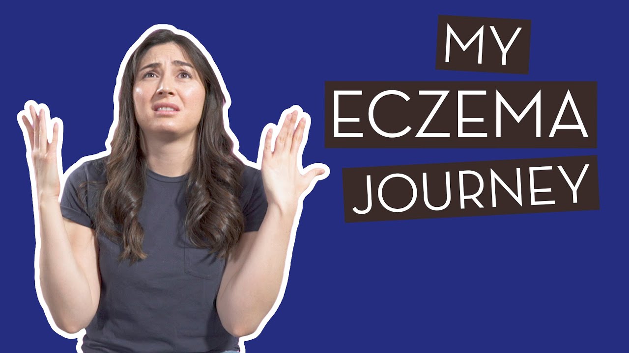 My Eczema Journey | How I Manage My Eczema Naturally