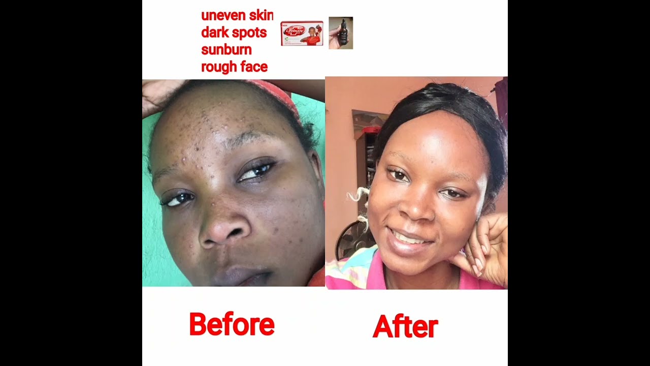 The truth about Pei Mei  vitamin C Serum and Lifebuoy soap |Dark spots|Uneven Skin| Bright face