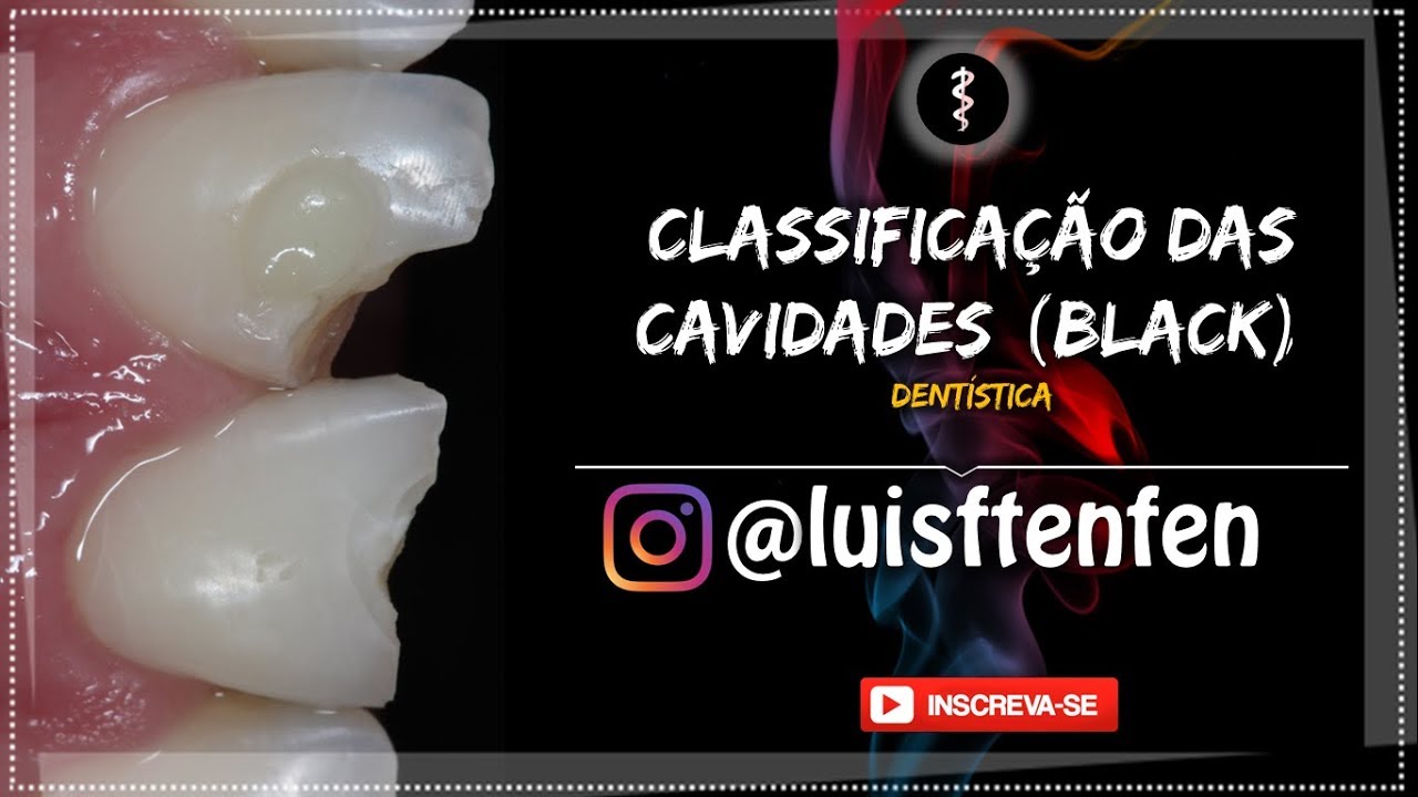 Classificação das Cavidades Segundo Black