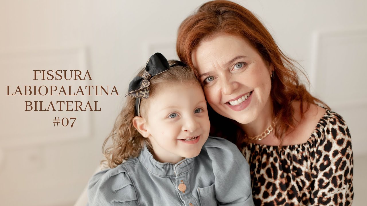 Minha Filha nasceu com Fissura Labiopalatina Bilateral #7