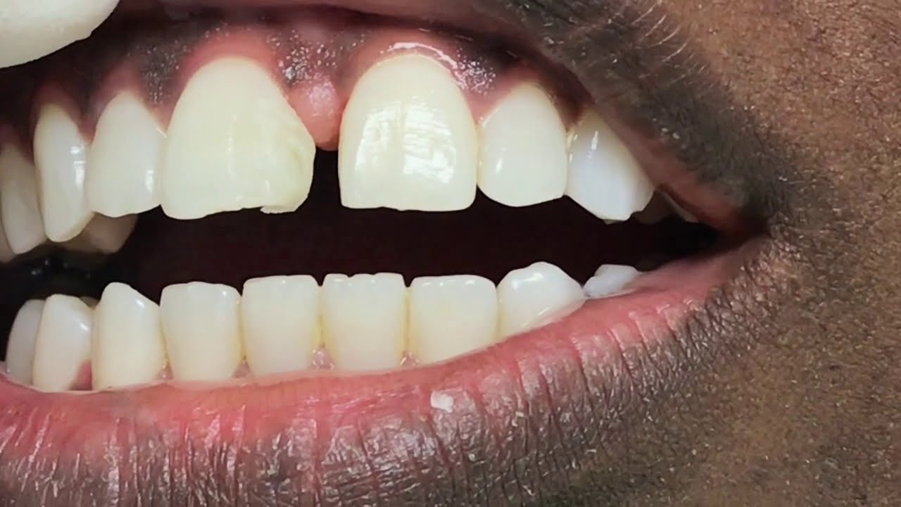 Houston Cosmetic Dentist...Got gaps? Simple affordable quick  solution with bonding