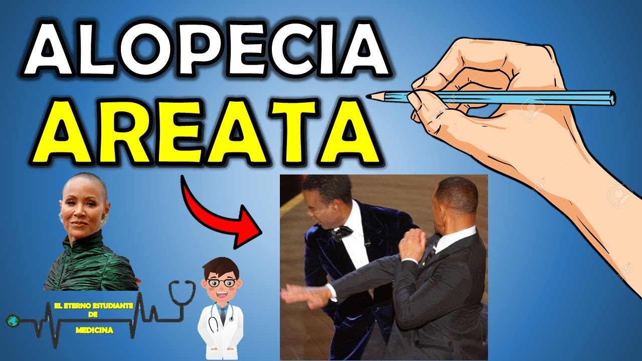 ¿Qué es la ALOPECIA AREATA? Tratamiento, Síntomas, Causas, Diagnóstico - Resumen 📝👨🏻‍⚕️