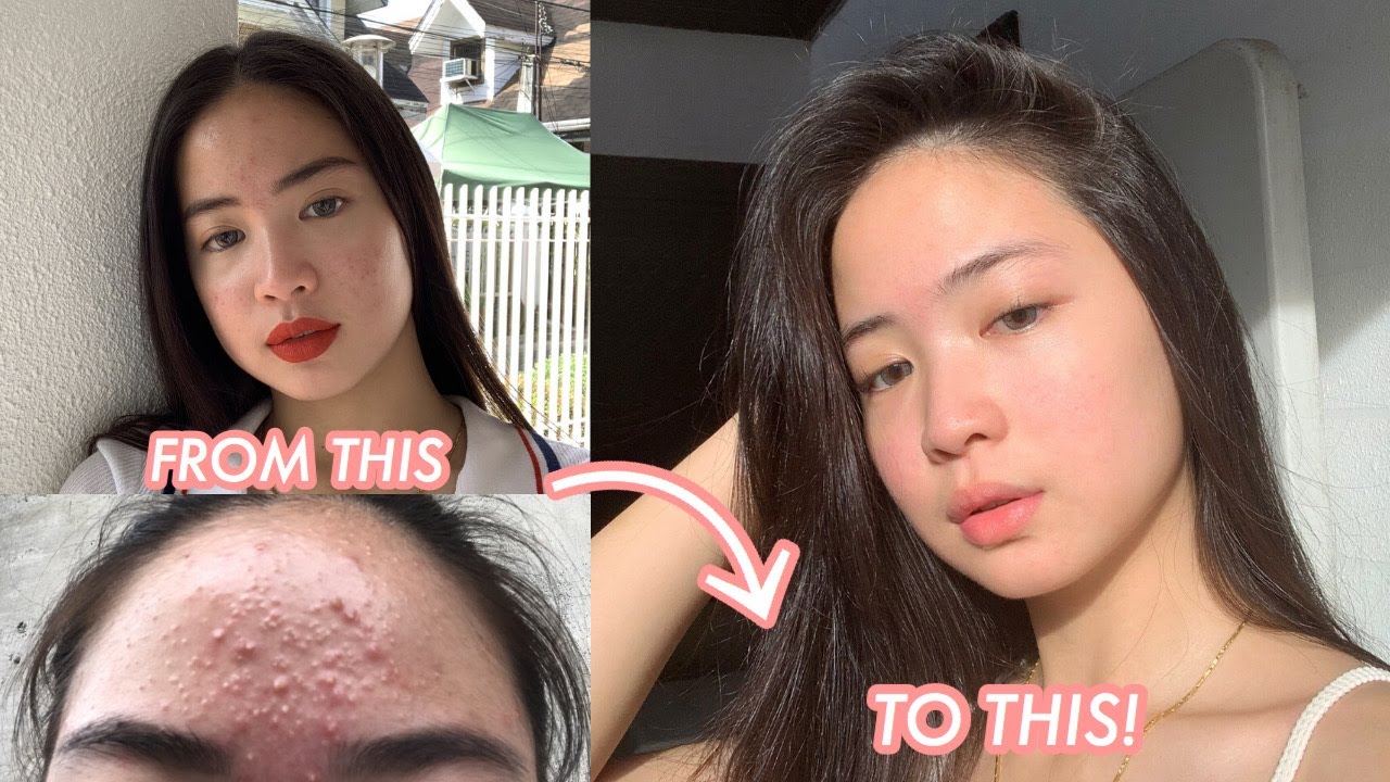 HOW I CLEARED MY SKIN?? 😱 (ACNE JOURNEY) | It's A