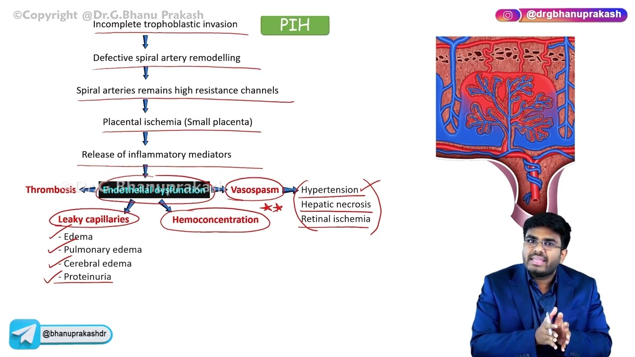 25. Pregnancy Induced Hypertension (Part -2): Obstetrics and Gynecology Lectures
