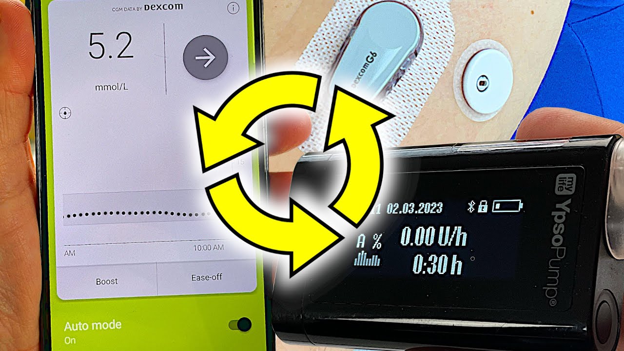 Лучшая автоматизированная система подачи инсулина? | Обзор mylife Loop CamAPS FX
