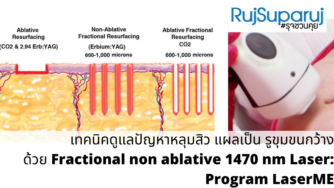 เทคนิคูดูแลปัญหาหลุมสิว แผลเป็น ด้วย Fractional non ablative 1470 nm Laser: Program LaserME