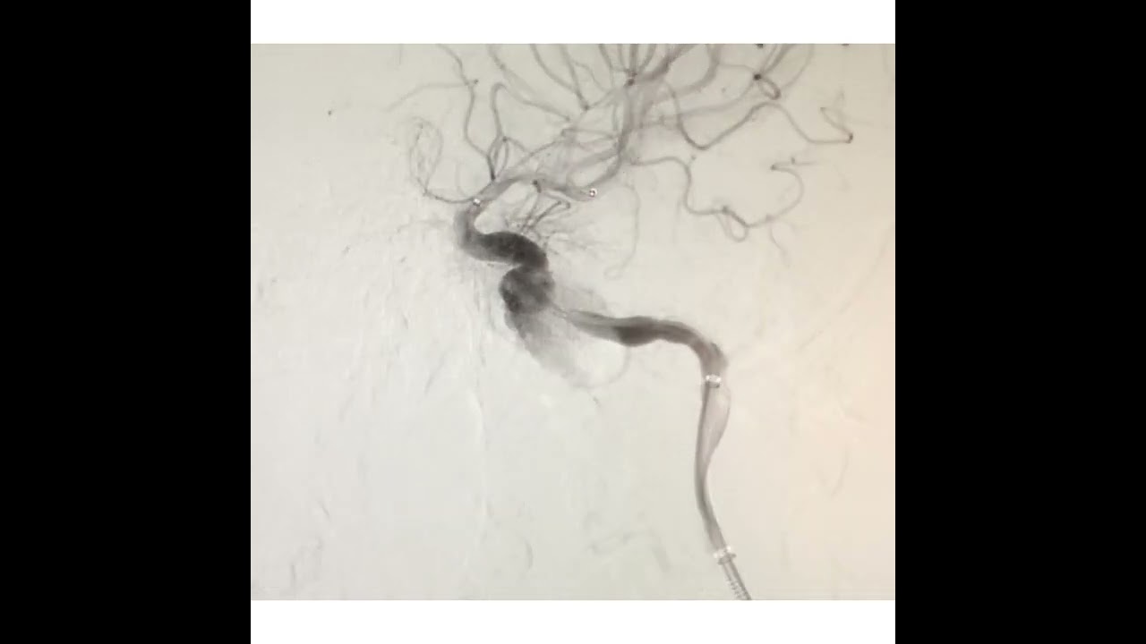 Flow Diverter ( FD ) Treatment for Brain Aneurysm