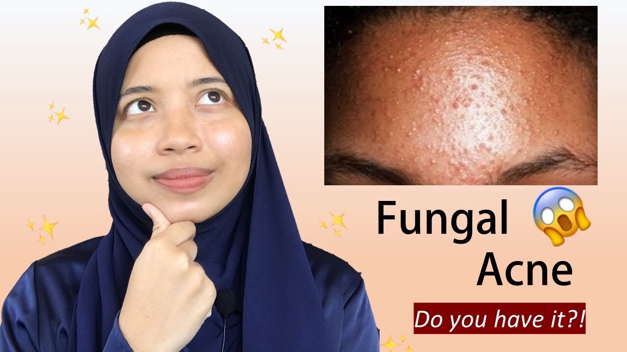 Everything You Need To Know About Fungal Acne!