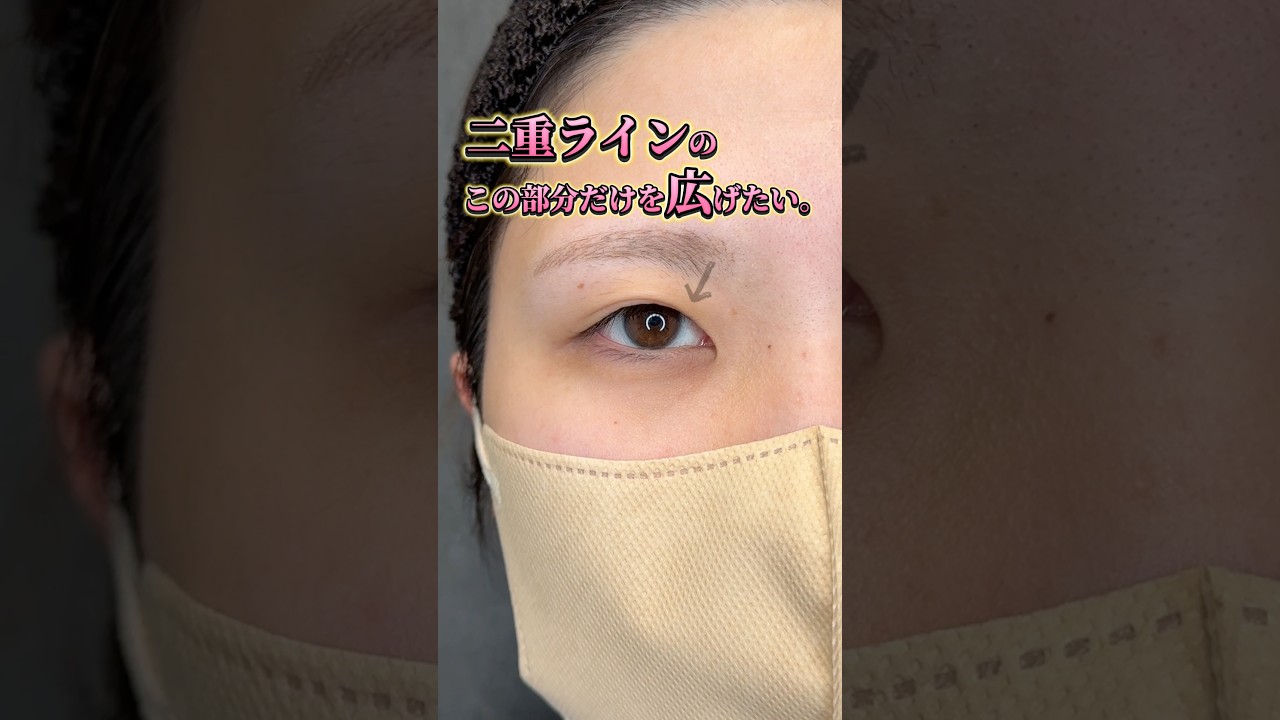 【蒙古襞があるけど目頭からしっかりした並行型二重にしたい方必見👀❣️】　