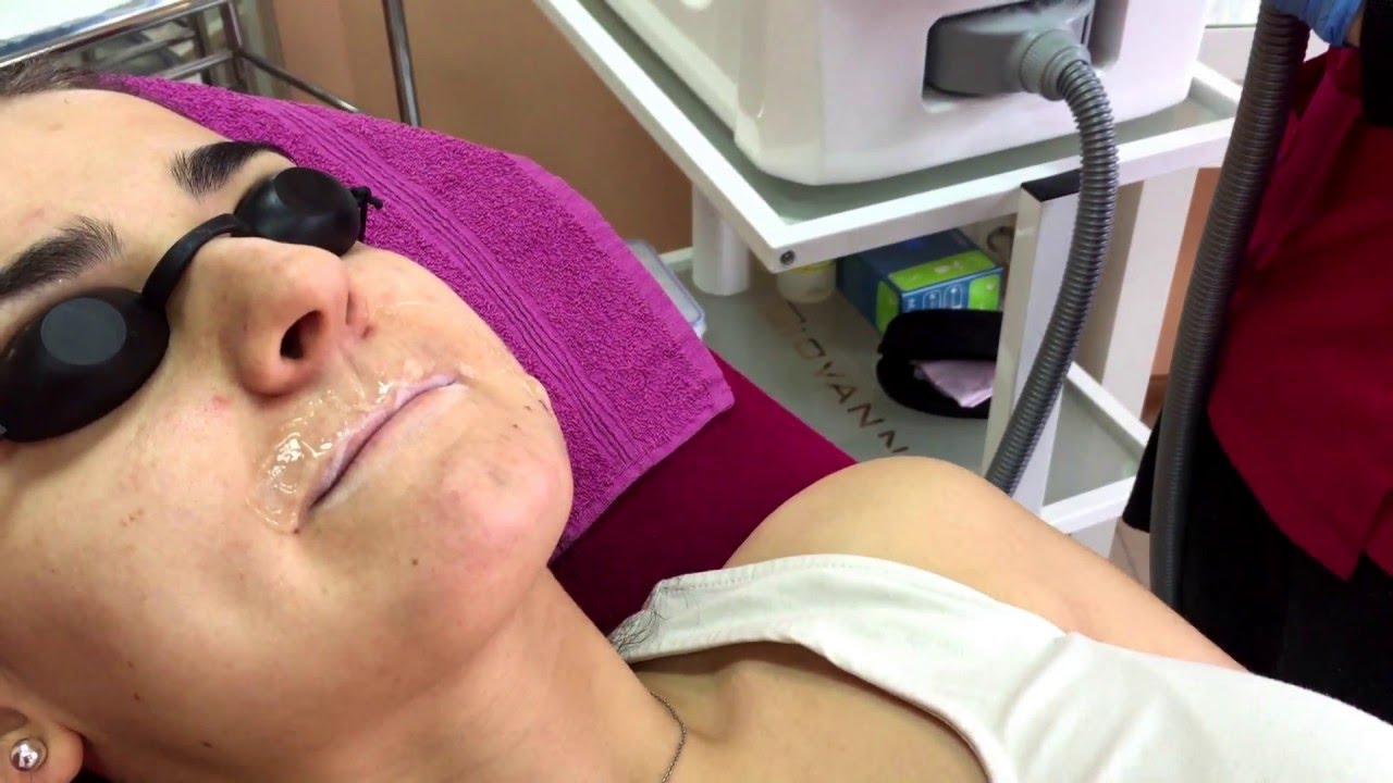 Depilacja laserowa wąsika IPL+RF ( E-Light ) Studio Urody Rumia