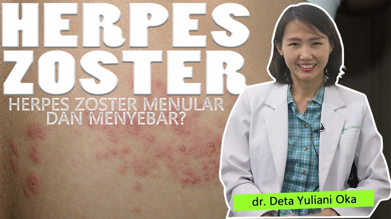 Apa Itu Herpes Zoster ? Ketahui Info Lengkapnya - dr. Deta Yuliani Oka
