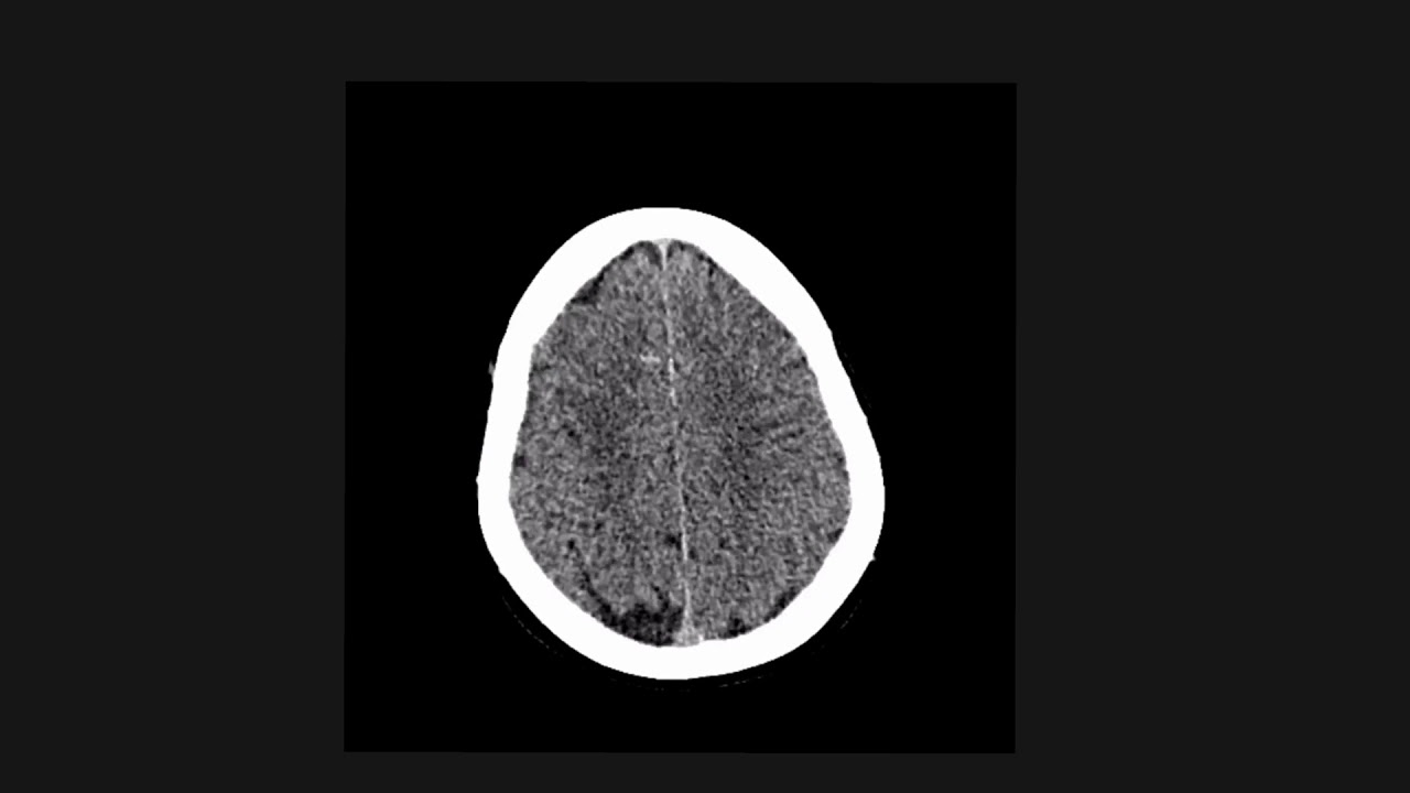 How to figure out non-traumatic causes of intracranial bleeding