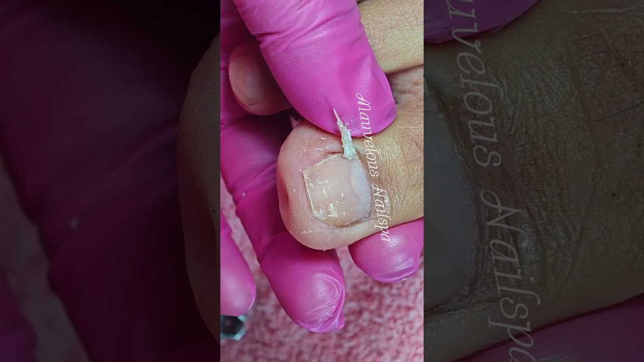 Full video pedicure with ingrown removal 
