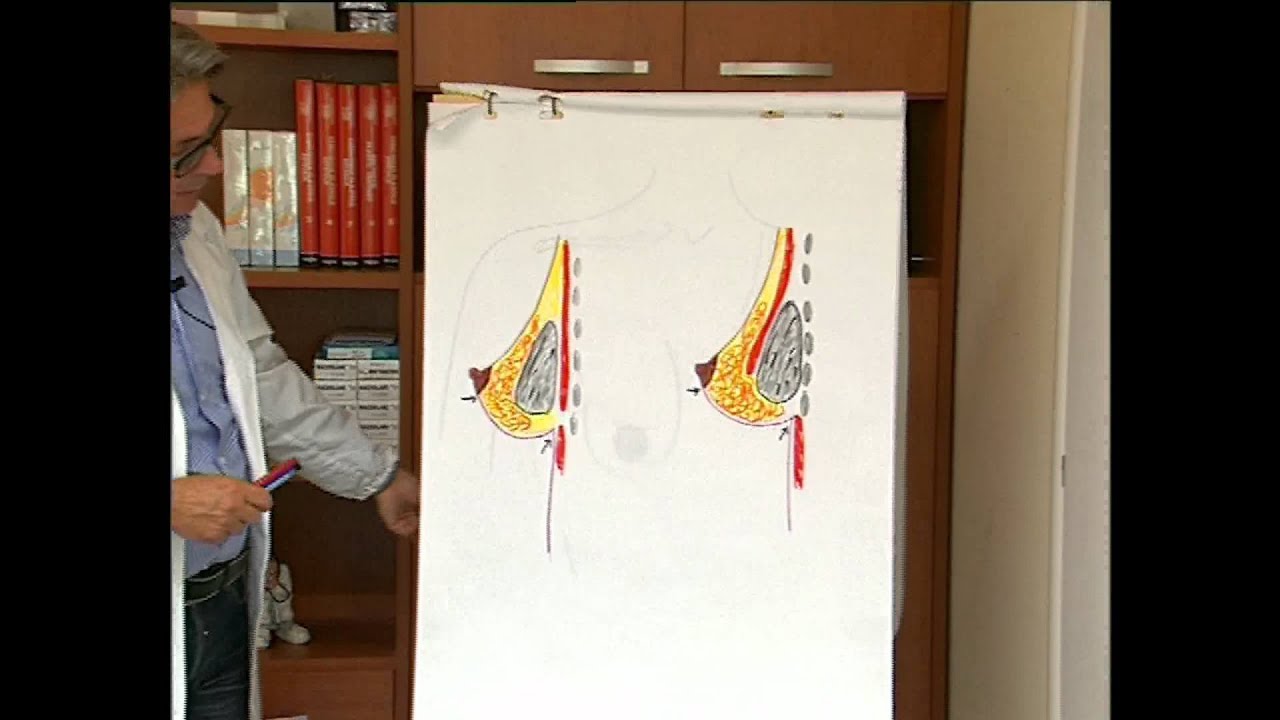 Mastoplastica additiva ep.2: intervento chirurgico di ingrandimento del seno