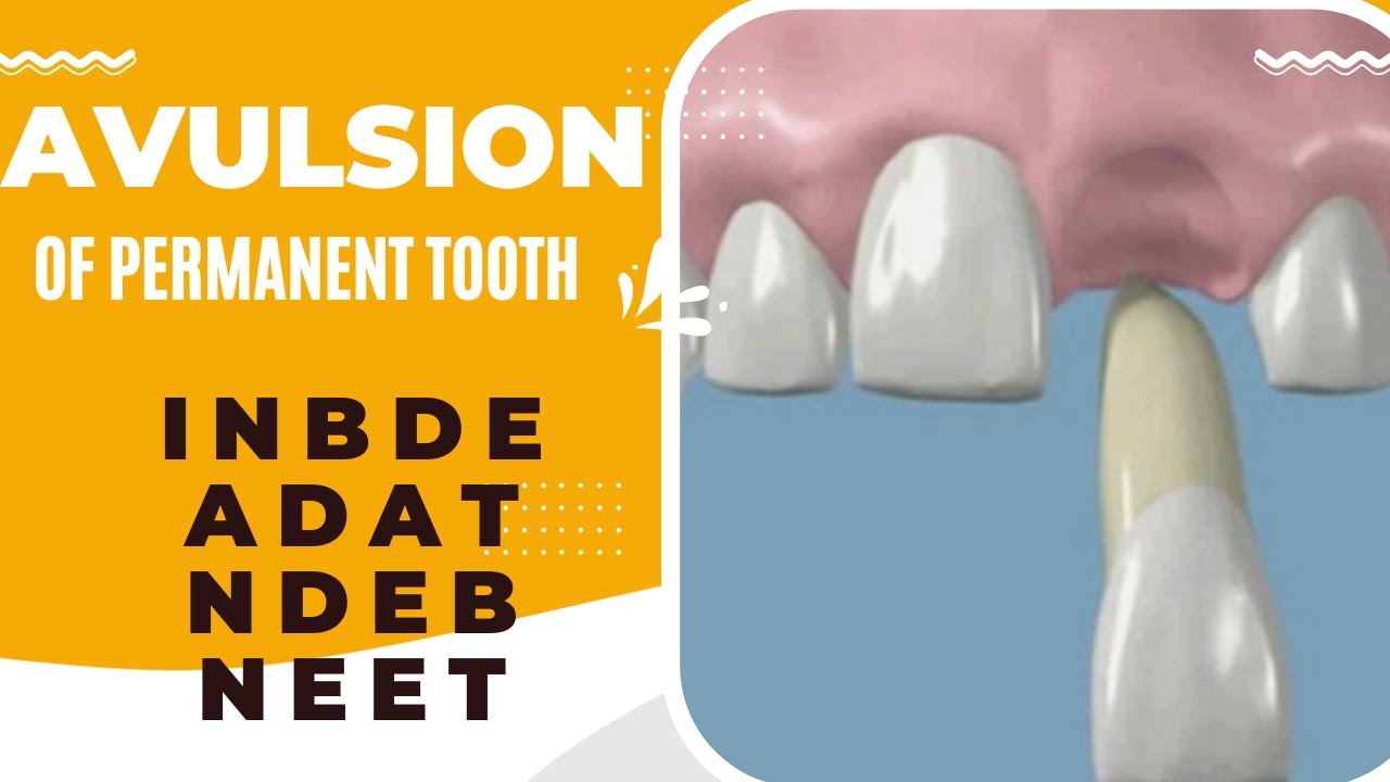 Avulsion of Permanent teeth- Dental Trauma Guidelines - iNBDE NEET AFK ADAT