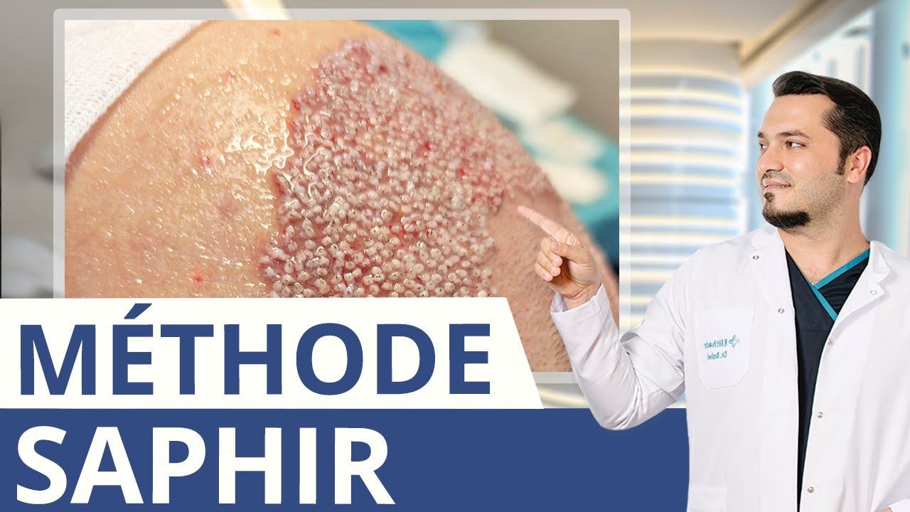 Qu'est-ce que la greffe de cheveux Saphir? Le Dr. Balwi explique!