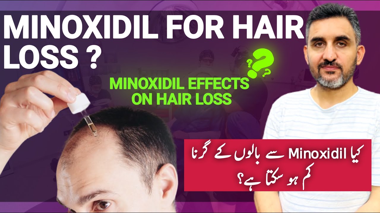 Minoxidil for Hair Loss: Does It Really Work? | Dr. Habib Explains