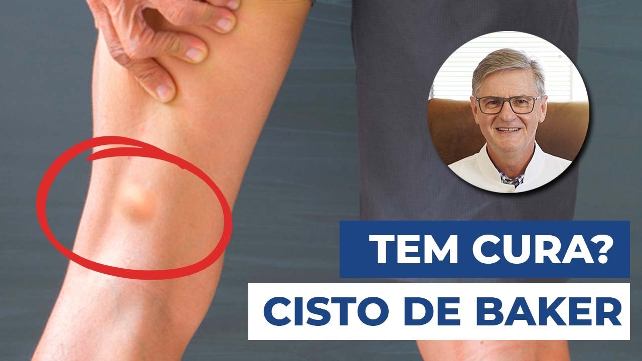 O que é Cisto de Baker ou Cisto na Poplítea? (Sintomas, Diagnósticos e Tratamentos)