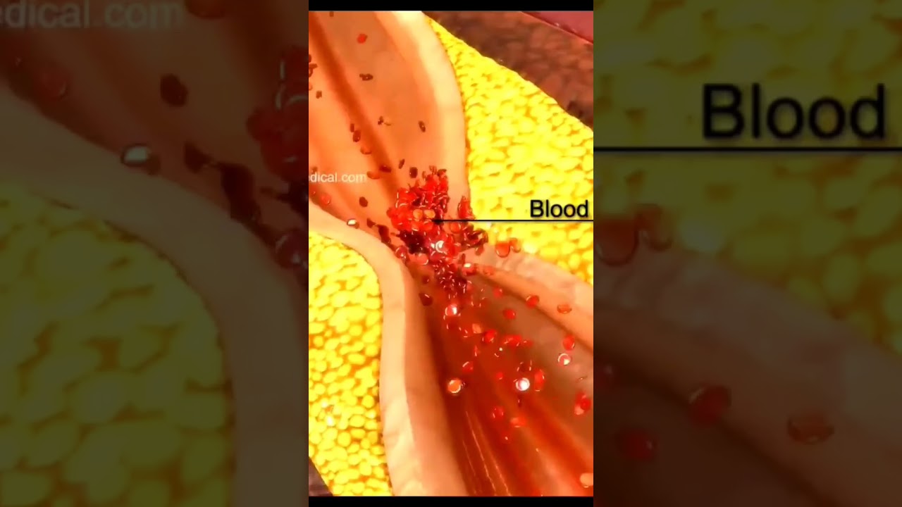 ACS & myocardial infarction 3D animation videos #shorts #health #medicine