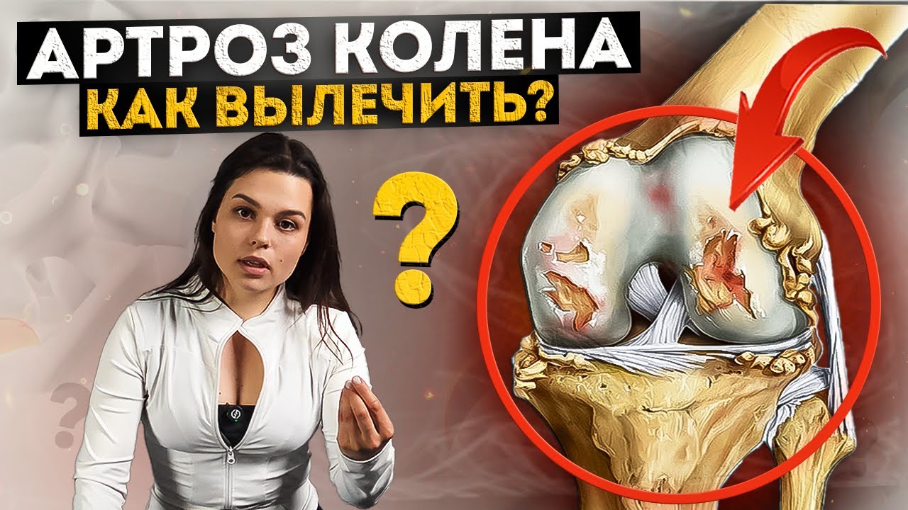 Вы никогда НЕ ВЫЛЕЧИТЕ артроз, если не будете делать ЭТО! Самый полный список рекомендаций! 