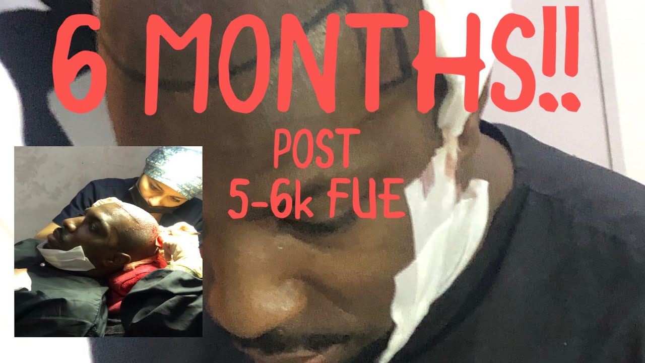 Ep24, 02/06/2022 - 6 MONTHS POST 5-6k FUE HAIR TRANSPLANT @ Asli Tarcan