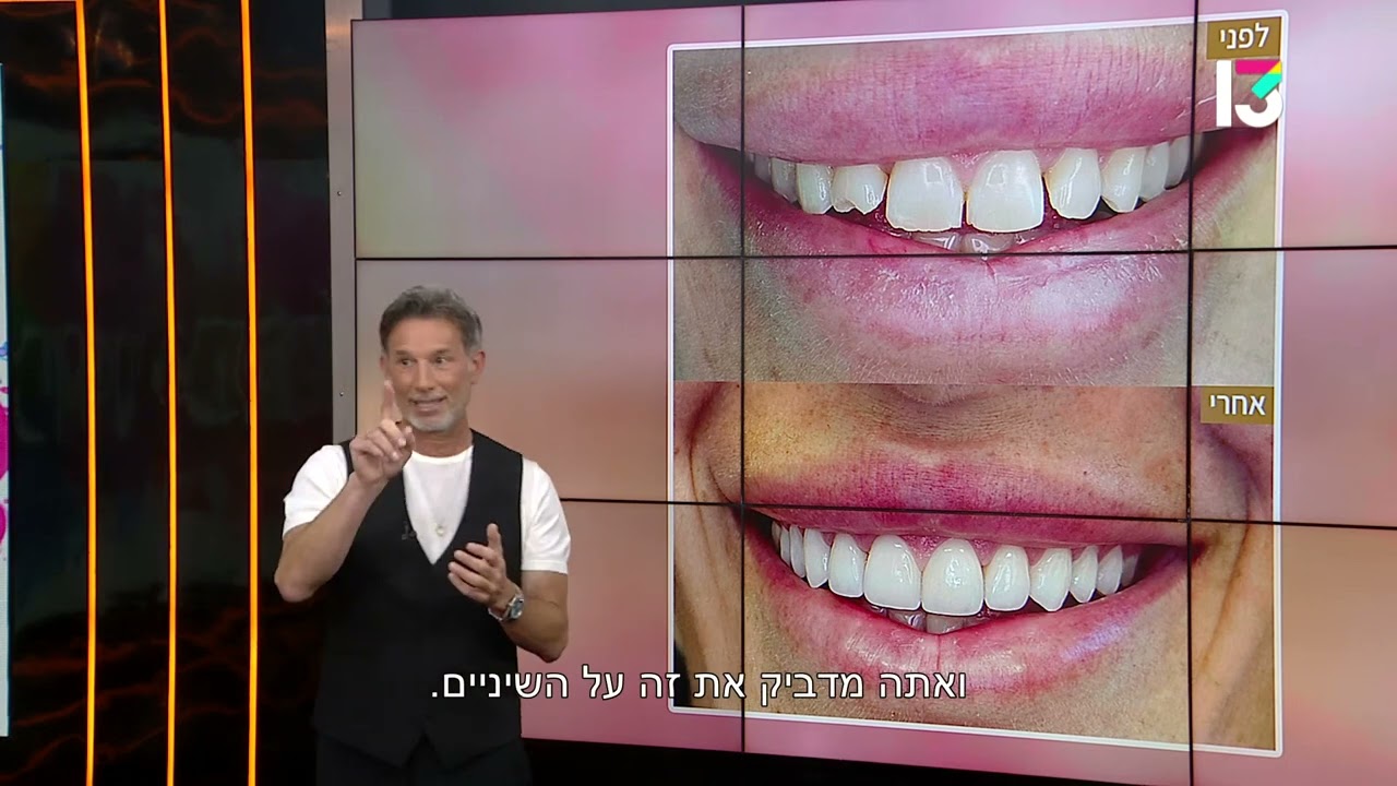 הבדלים בין השלמה קומפוזיטית לציפויי חרסינה – ד״ר פיסקוס מסביר ומדגים בביוטי בלנדר