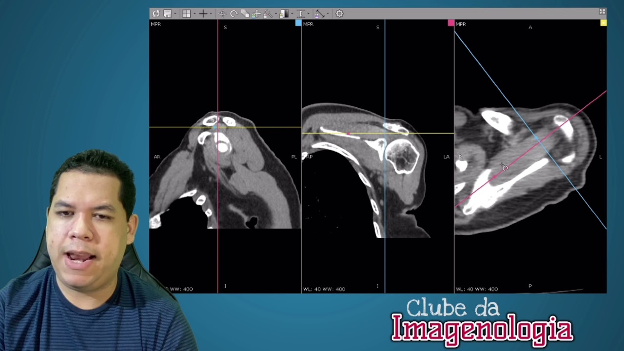 Reconstrução de imagens por Tomografia #02 Clube da Imagenologia