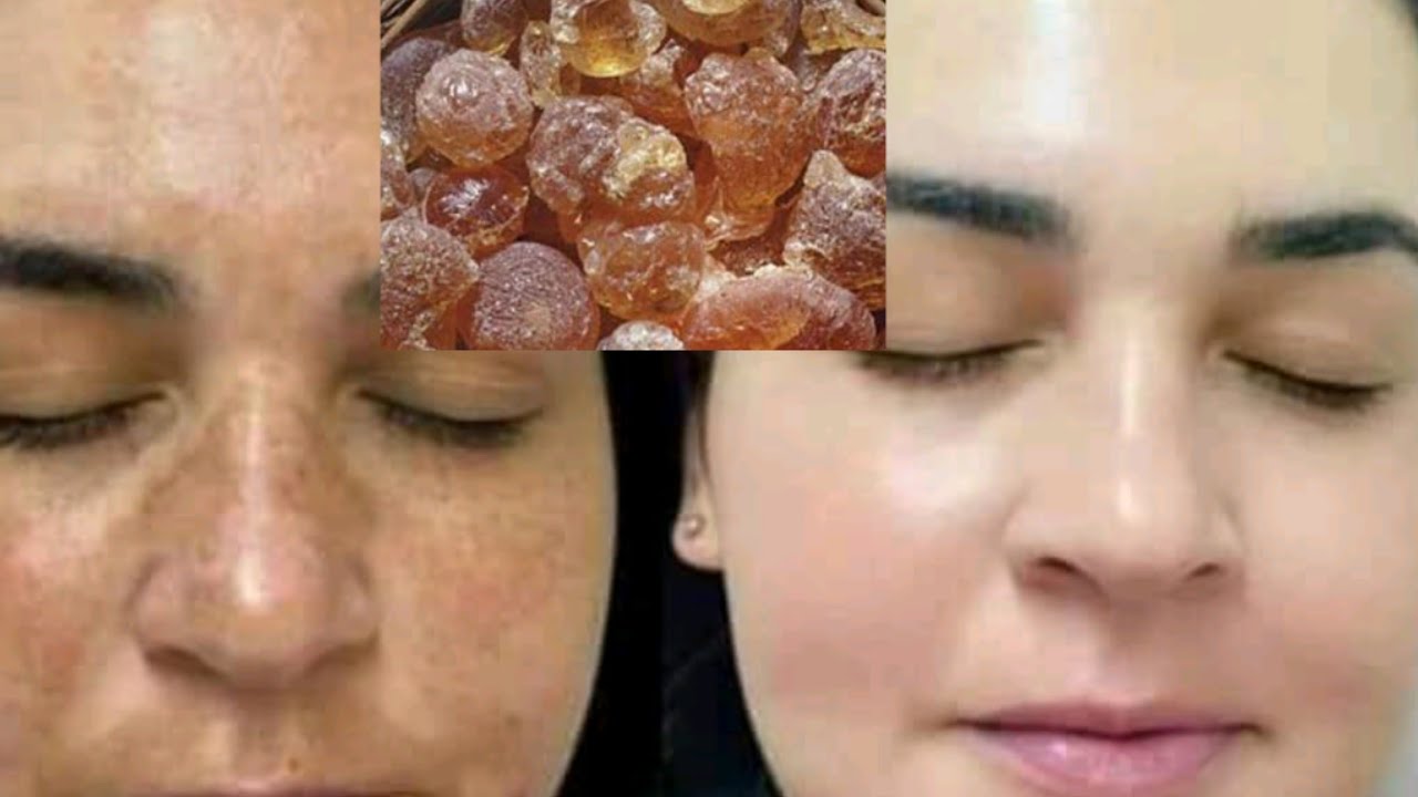 ماسك العـلك ينافـس جمـيع منتجات التجمـيل يزيل التـصبغات ,الكلـف و حبـوب الشـباب Masque Anti-âge