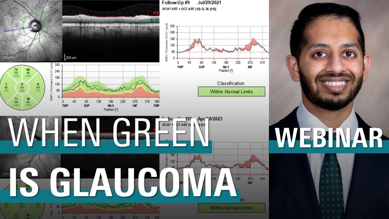 When Green is Glaucoma – OCT Pearls for Clinical Management of Glaucoma