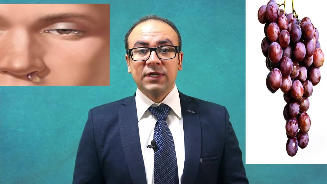 يعني إيه صداع عنقودي و كيفية علاجه.