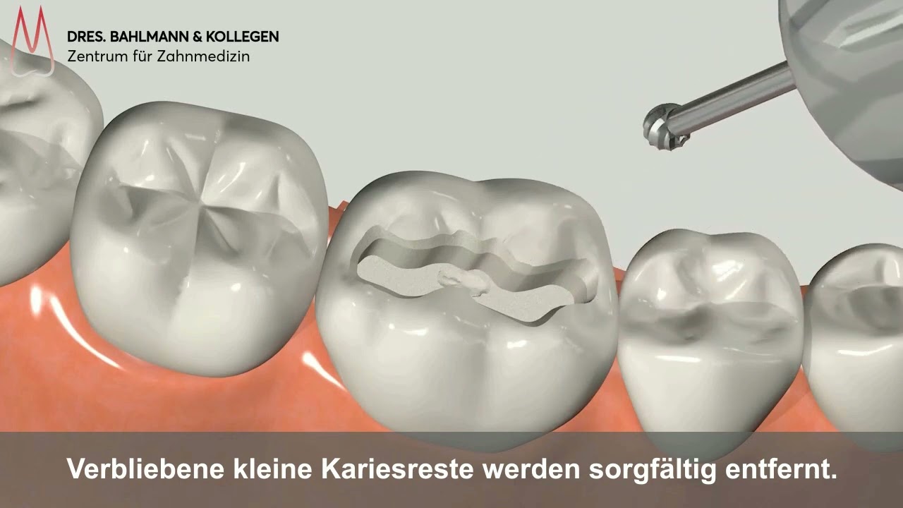 Zahnf&uuml;llung K&ouml;ln - Erkl&auml;rvideo - Ablauf
