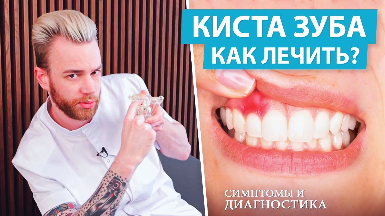 Киста зуба - как лечить. Симптомы и диагностика кисты зуба