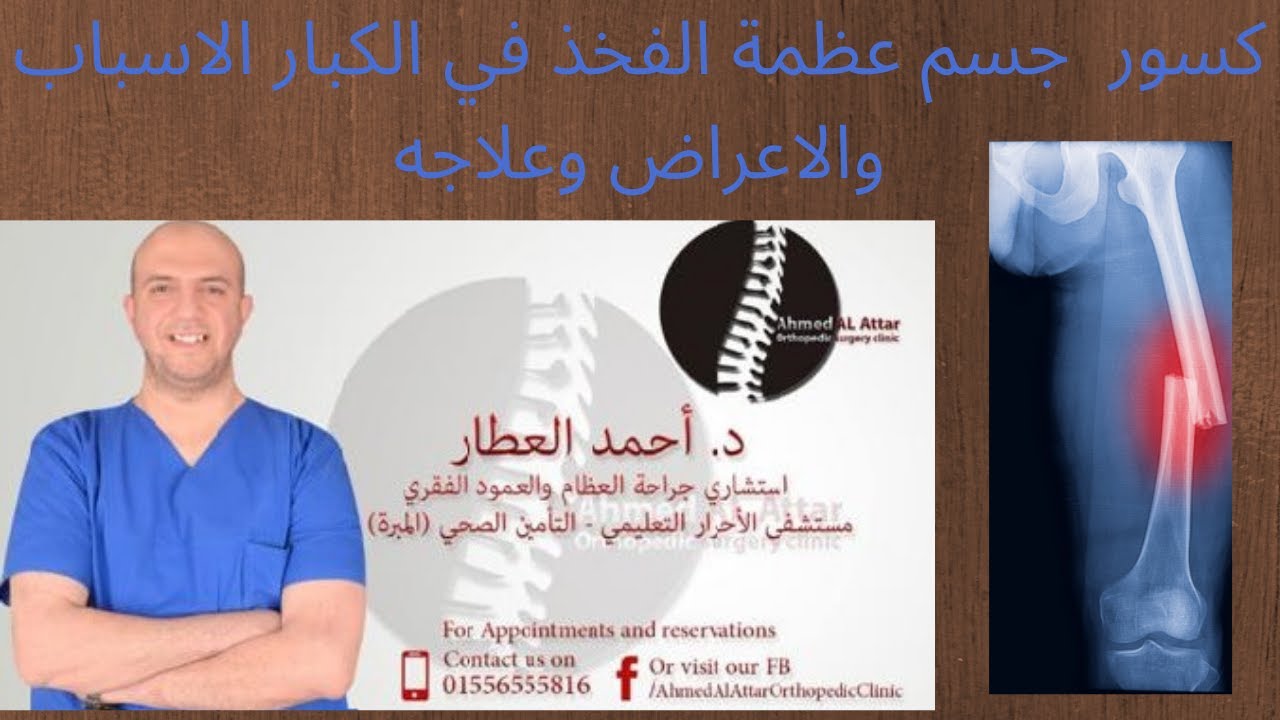 كسور  جسم عظمة الفخذ في الكبار الاسباب والاعراض وعلاجه