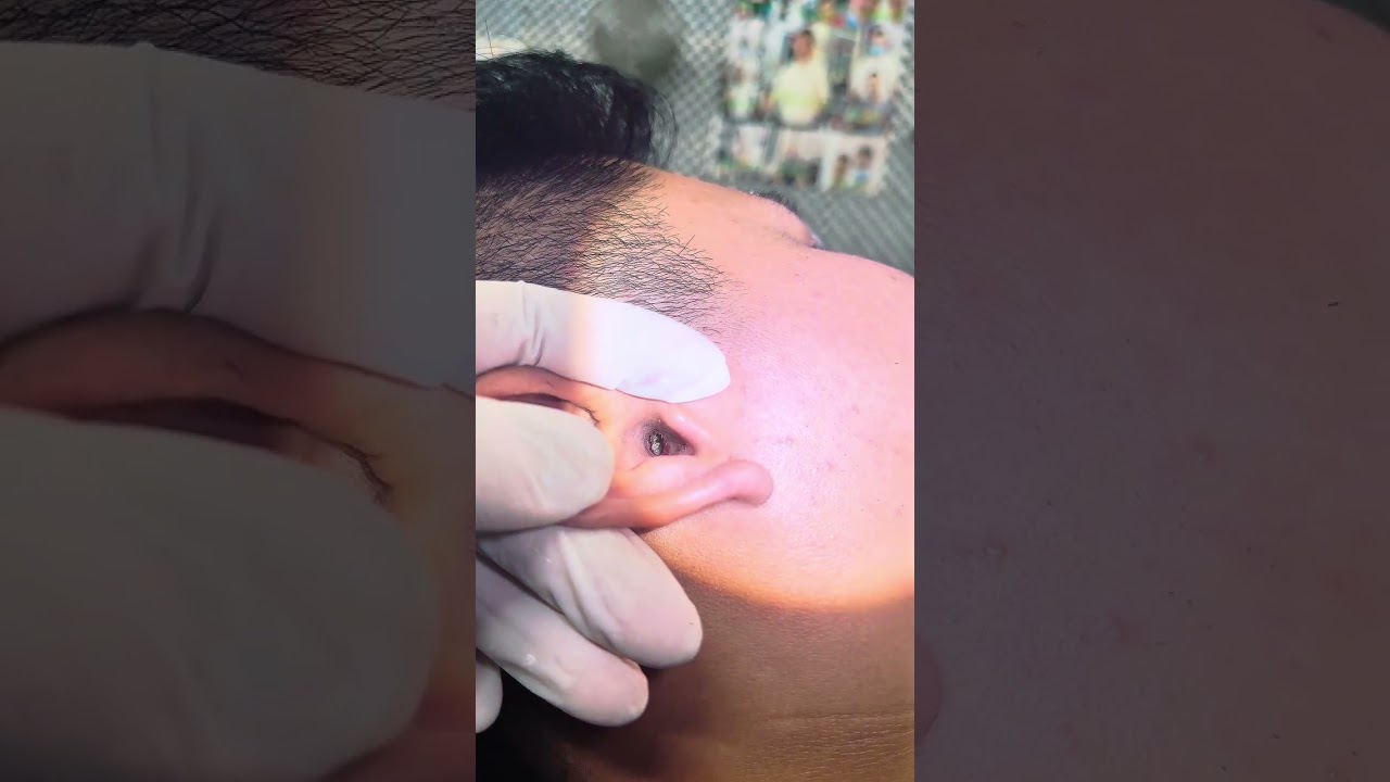 The Most Satisfying Ear Wax Removal Ever | Deep Ear Cleaning ASMR