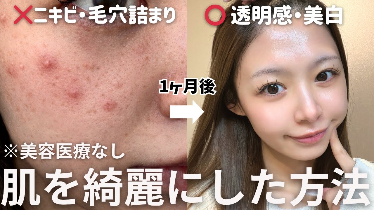 【ニキビ・肌荒れ】9割が知らない生活習慣をやめたら、1ヶ月で肌が別人に👶🏻✨美容医療なし❌