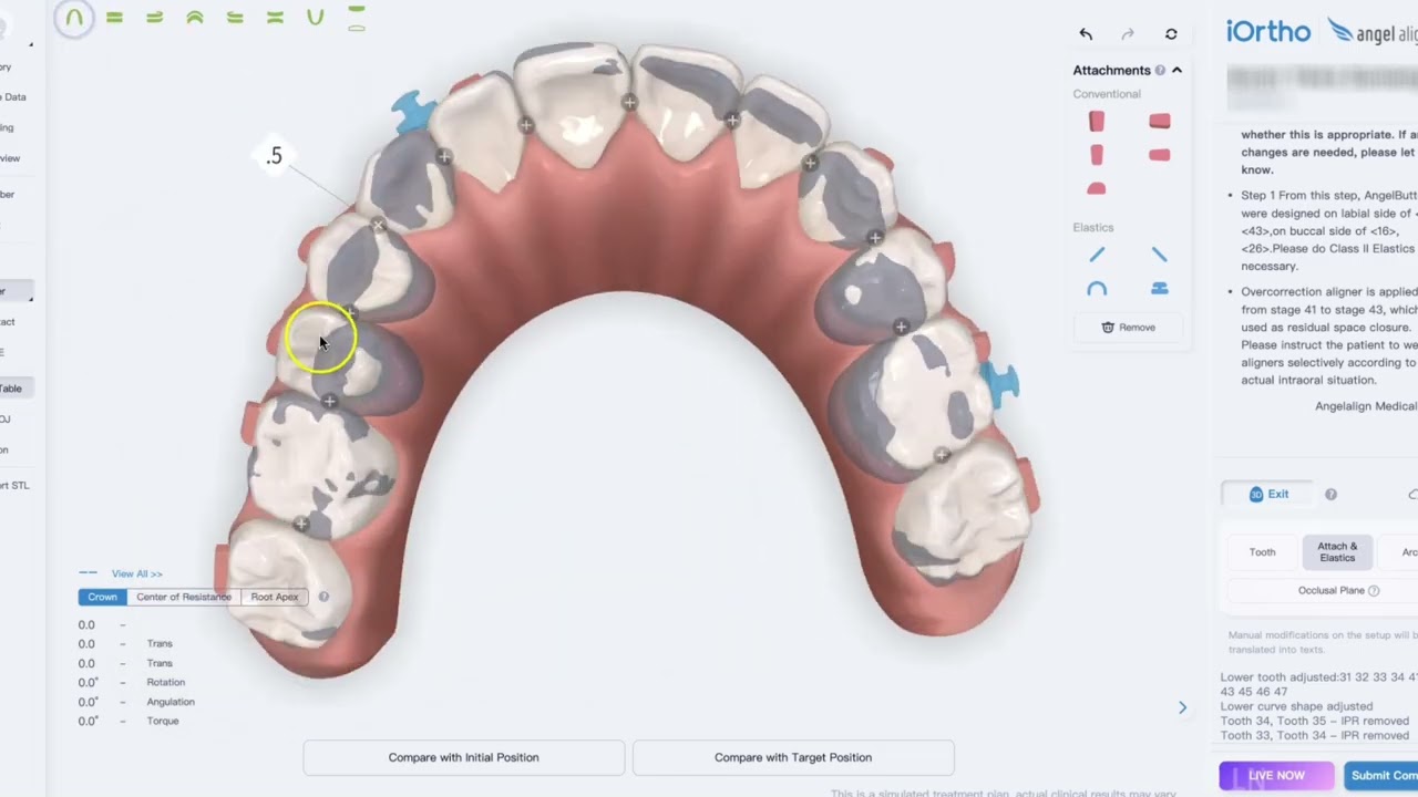 Inside a Real Angel Aligner Case Coaching Session