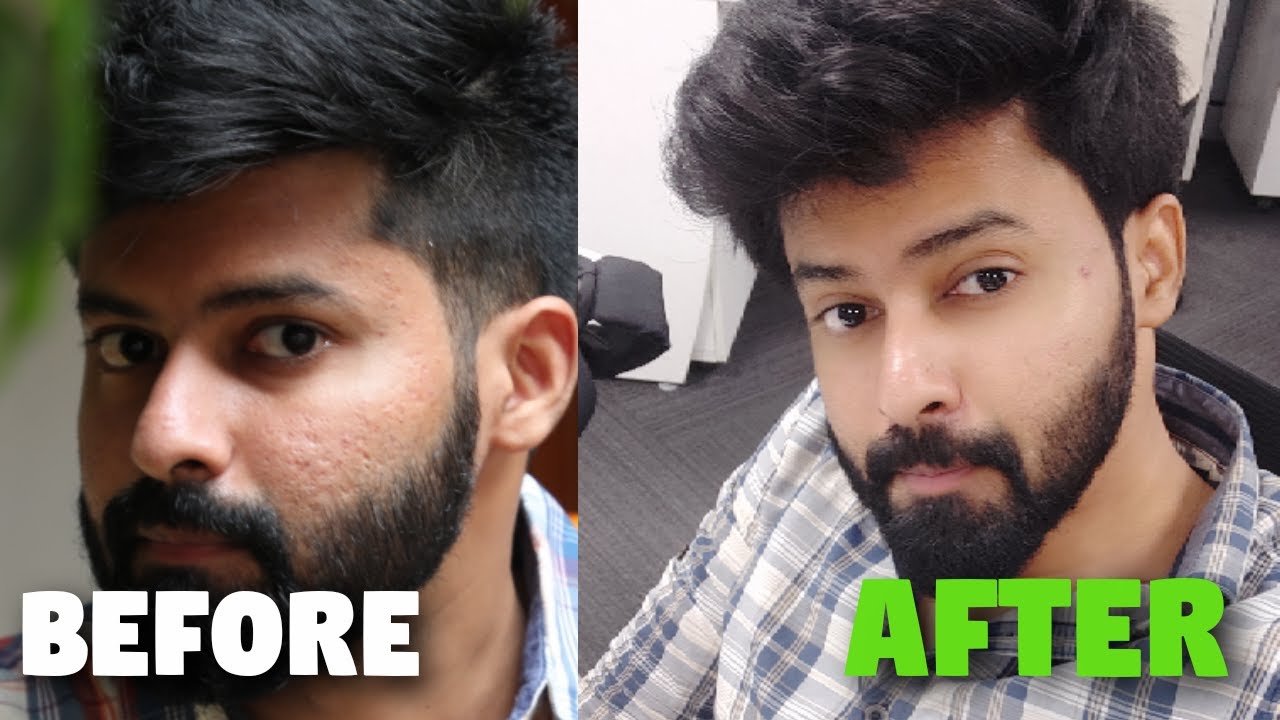 Minimise Large Pores | Acne Scars Control | முகத்தில் உள்ள பள்ளம் நீங்க இதைத்தான் செய்யனும்