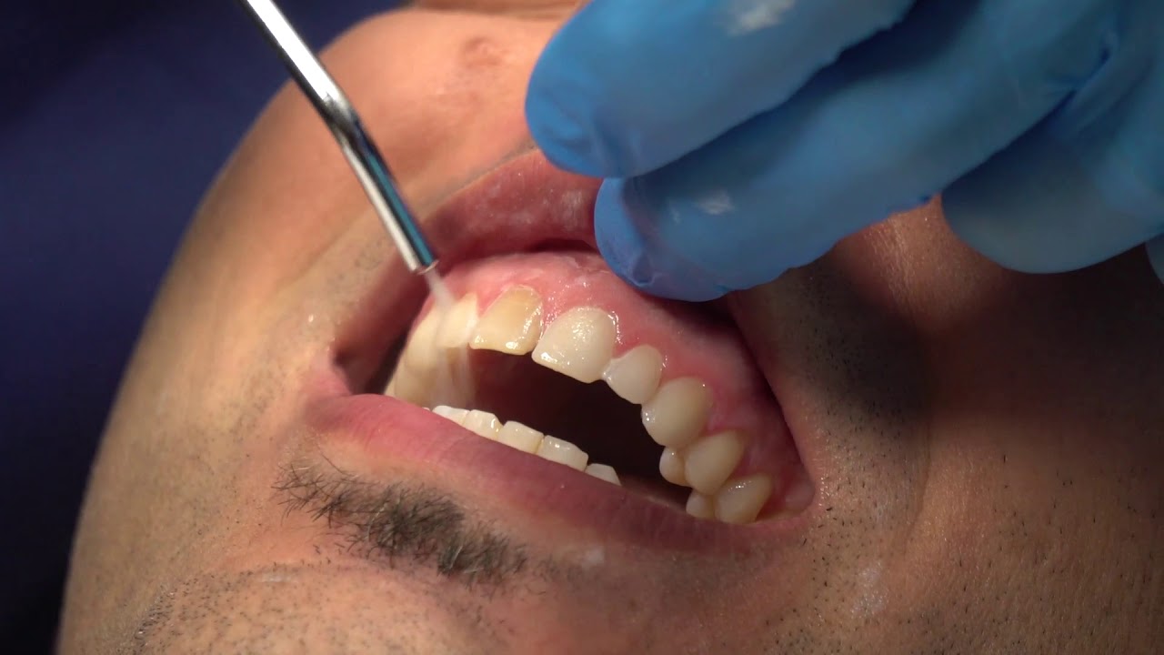 Watch Dr. David Ouellet place 10 Lumineers during DenMat's live CE course  - DenMat Dental Education