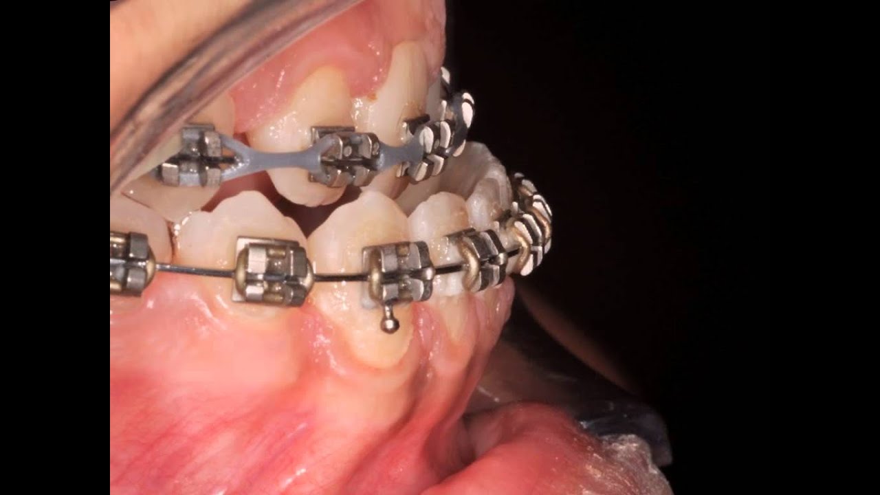 Class III  - Orthodontic surgical treatments