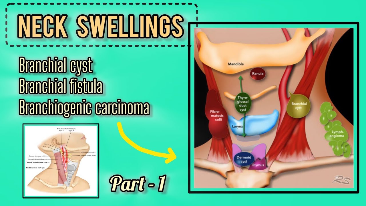 Congenital Neck swelling | Branchial cyst, fistula, carcinoma part -1