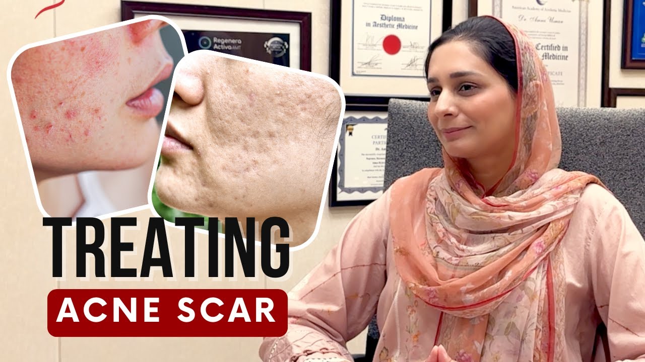 Microneedling for Acne Scars: FAQs Answered by Dr. Amna | Effective Acne Scar Treatment