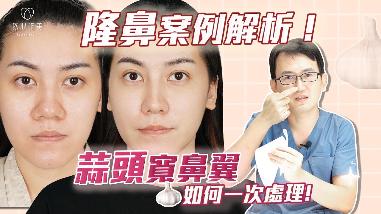如何設計專屬隆鼻？縮鼻翼疤痕明顯？直接放大公開！一次改善蒜頭鼻、鼻翼寬、鼻基底（貴族手術）｜依心唯美 謝東穎醫師