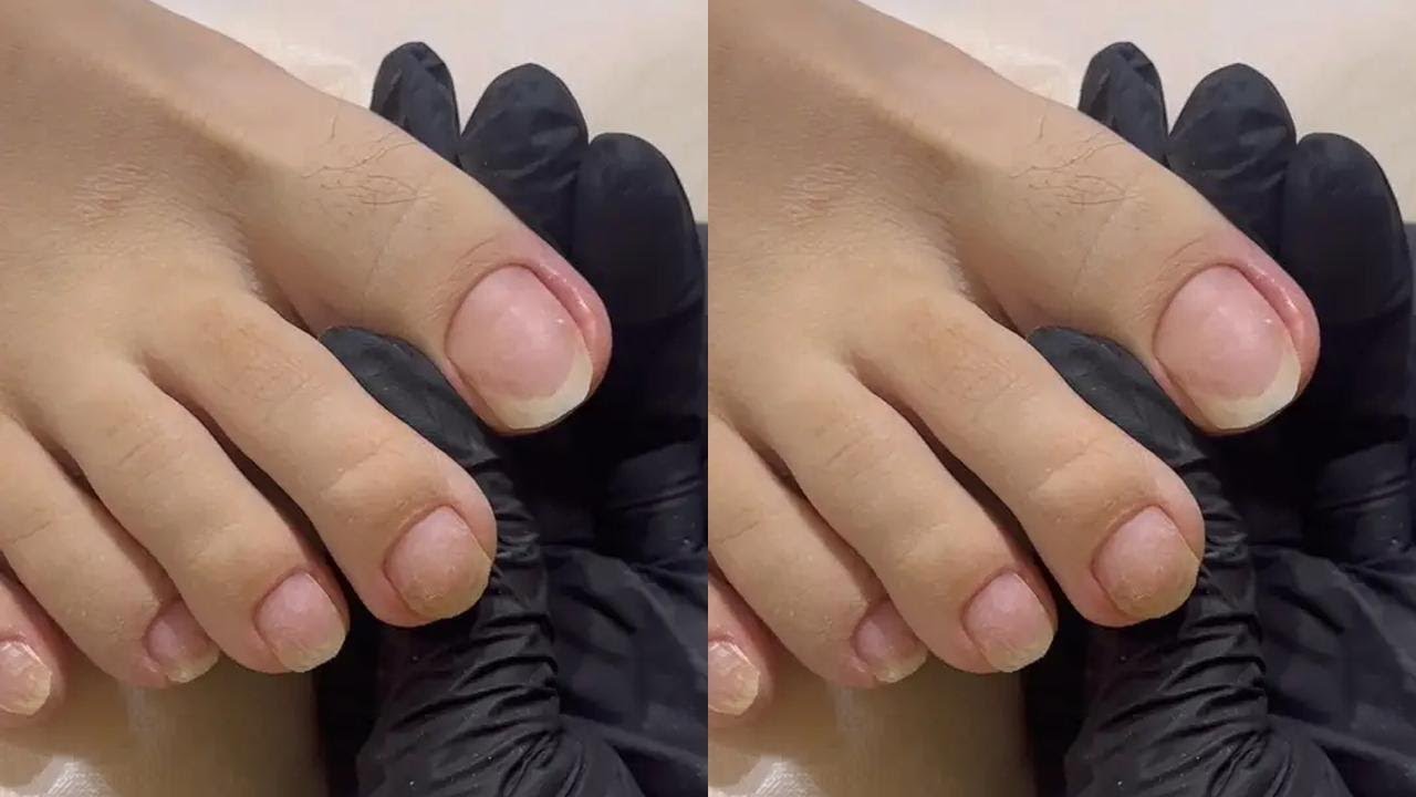 #美甲💅 #专业修脚 #脚趾甲 #嵌甲 #甲沟炎