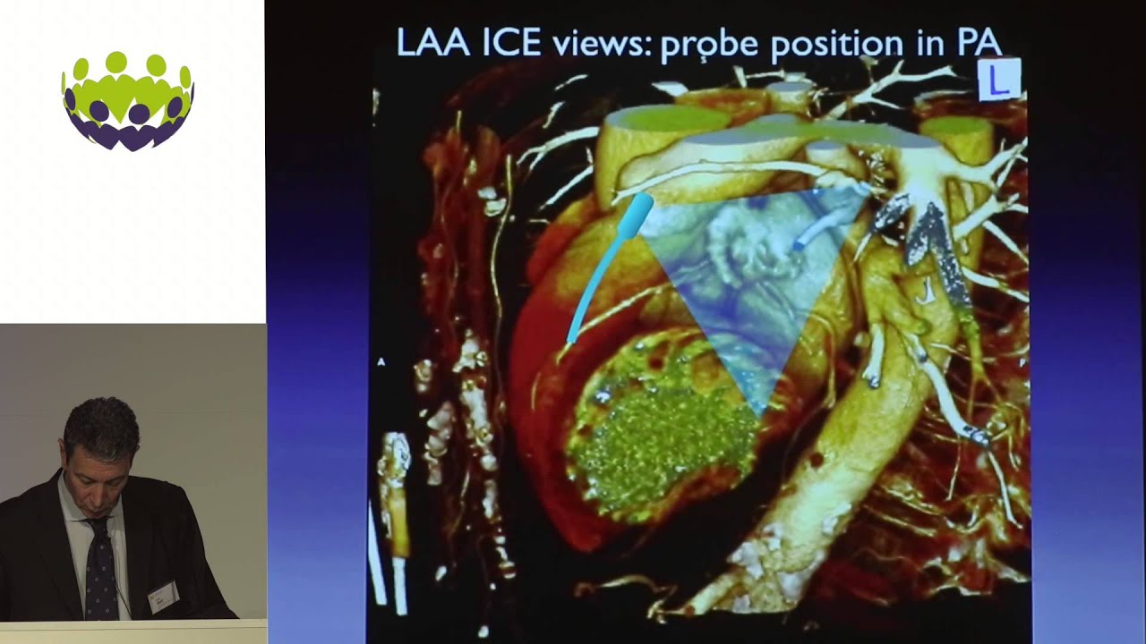 Sergio Berti - A didactic challenge; use of IntraCardiac Imaging for LAA occlusion implantiation