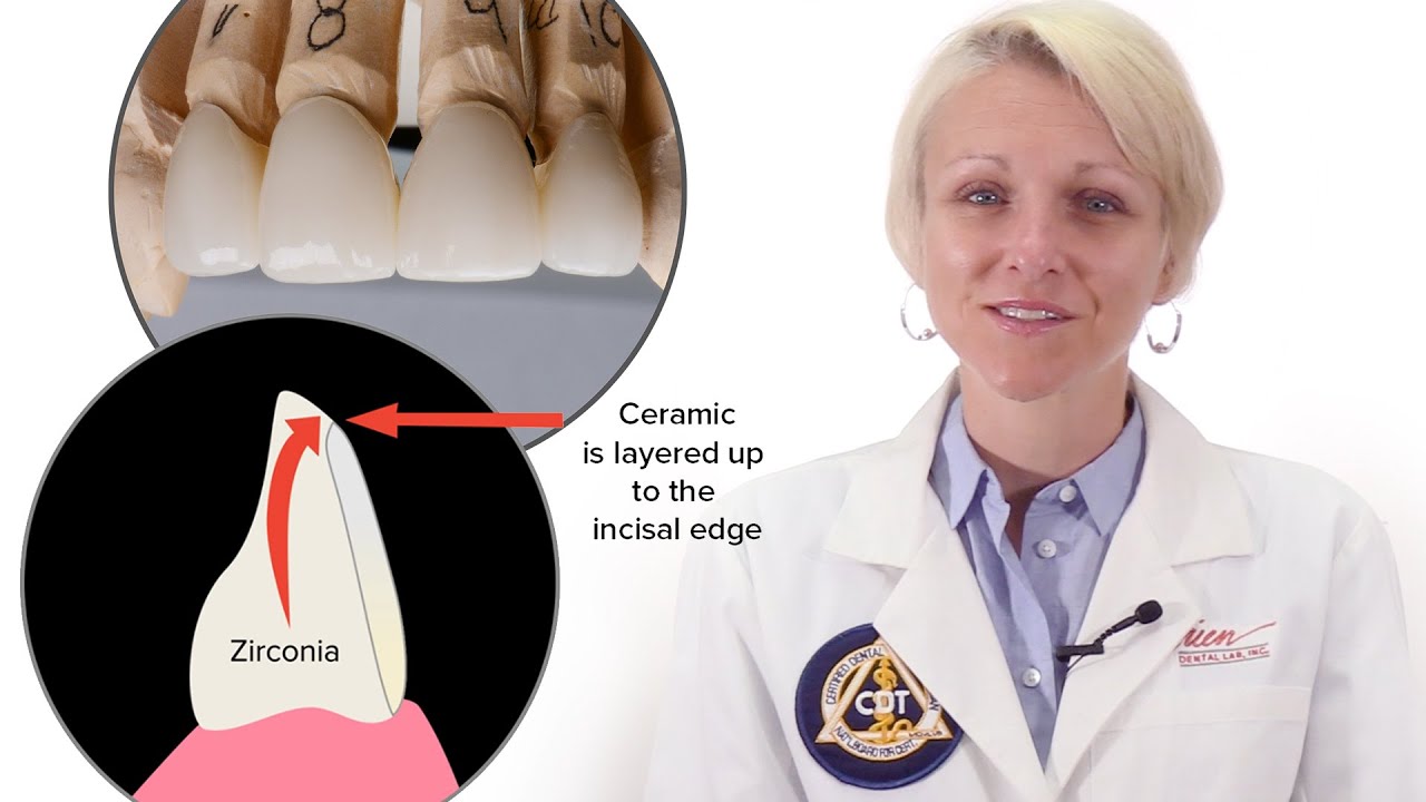 Micro Layered Zirconia Crowns