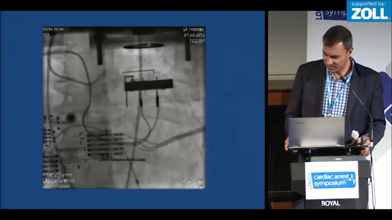 AutoPulse in Cath Lab, an Interventional Cardiologist’s View of Sudden Cardiac Death