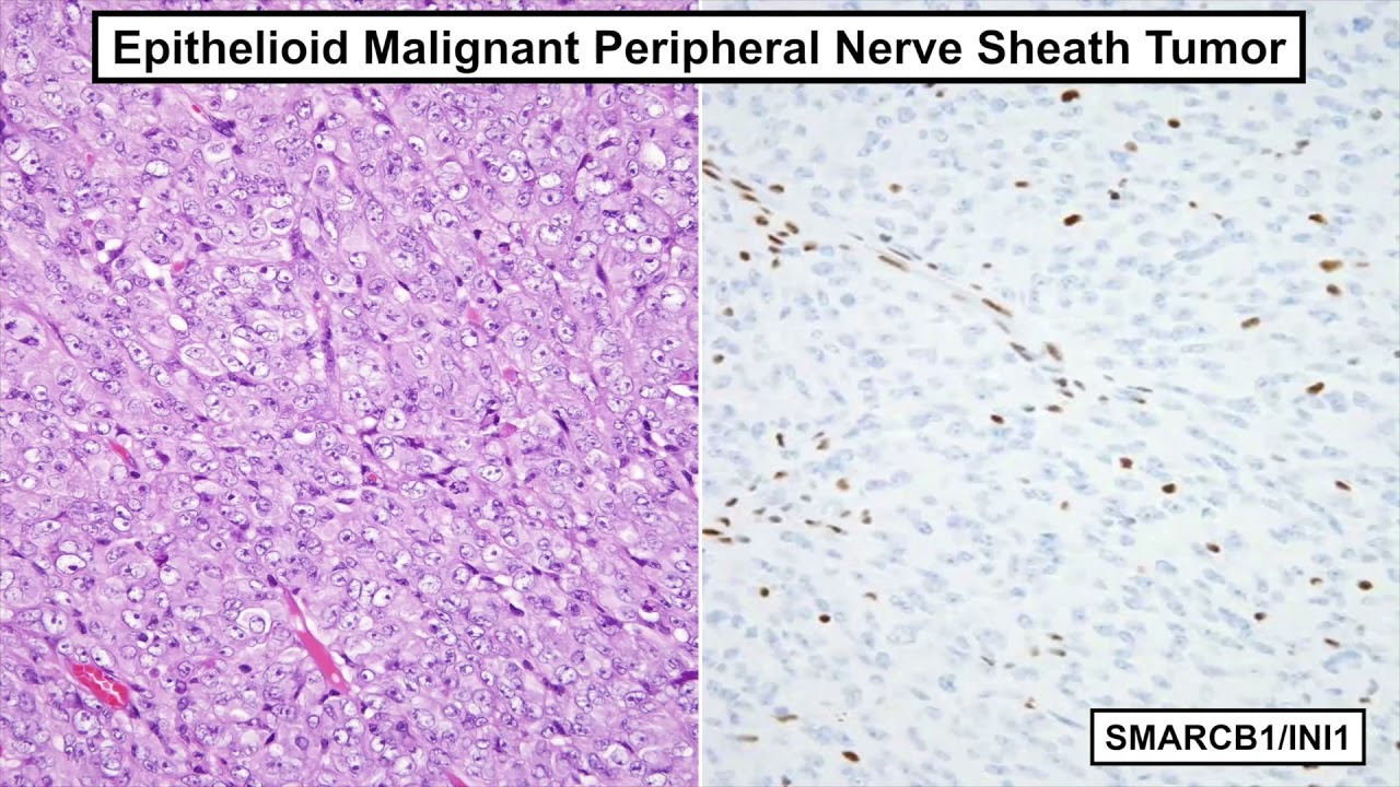 Surgical #Pathology Update: Diagnostic Pearls for the Practicing #Pathologist - Volume V