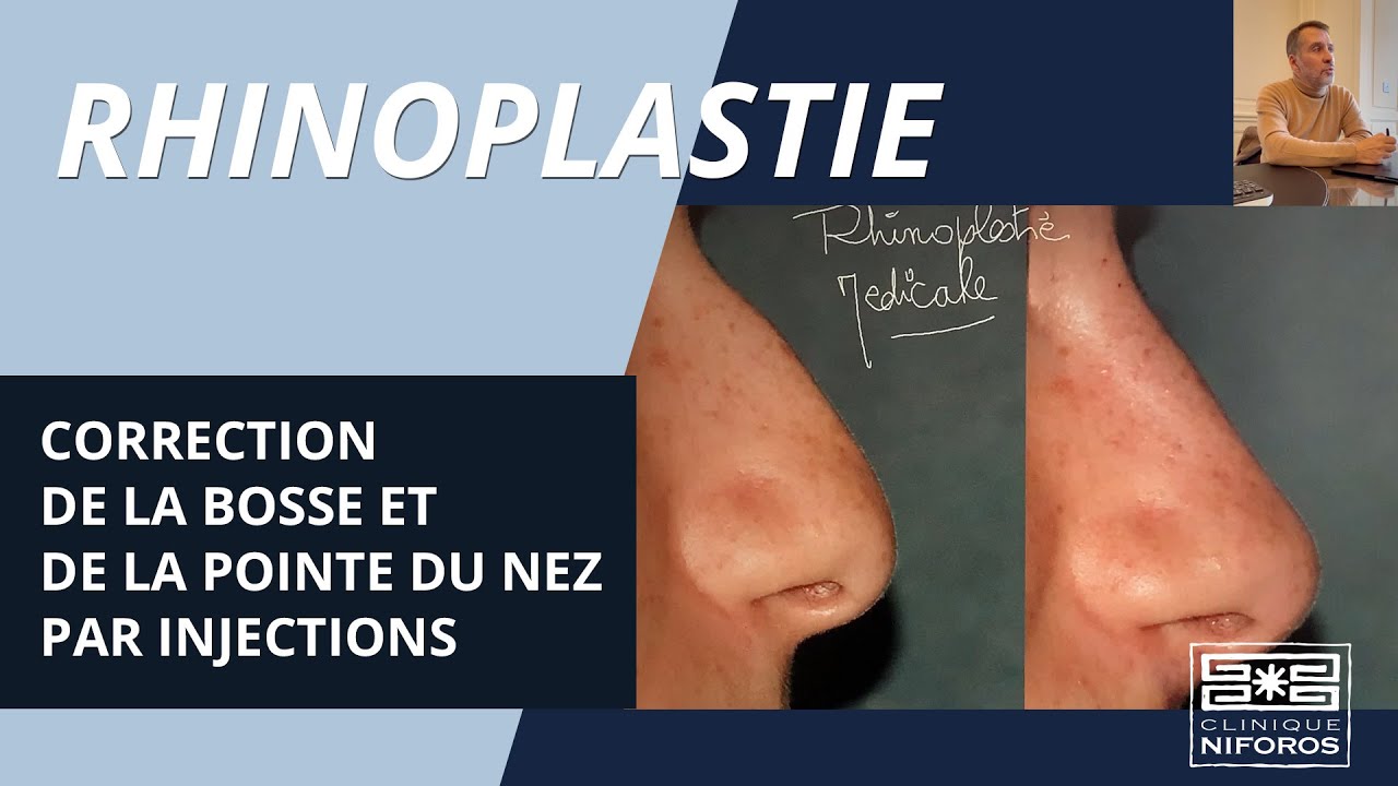 Correction de la bosse et de la pointe du nez par injections (rhinoplastie médicale)
