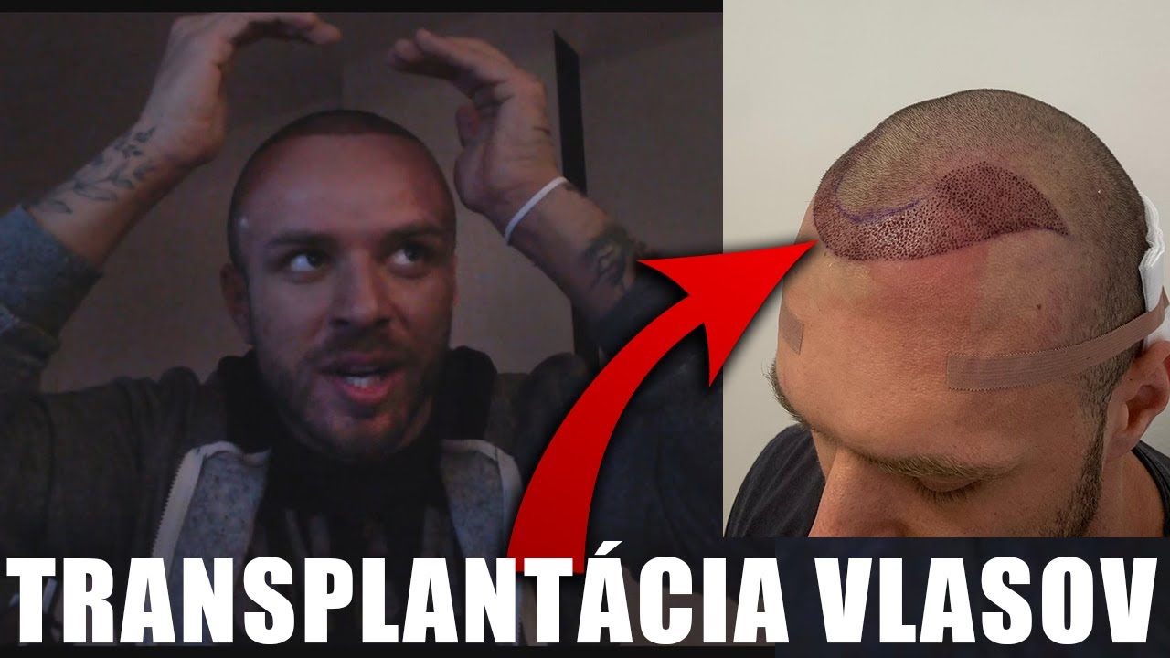 Restt Má Nové Vlasy - TRANSPLANTÁCIA VLASOV